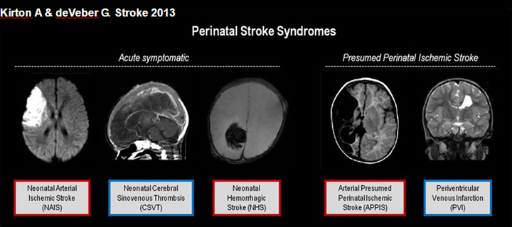 Perintal Stroke Syndrom